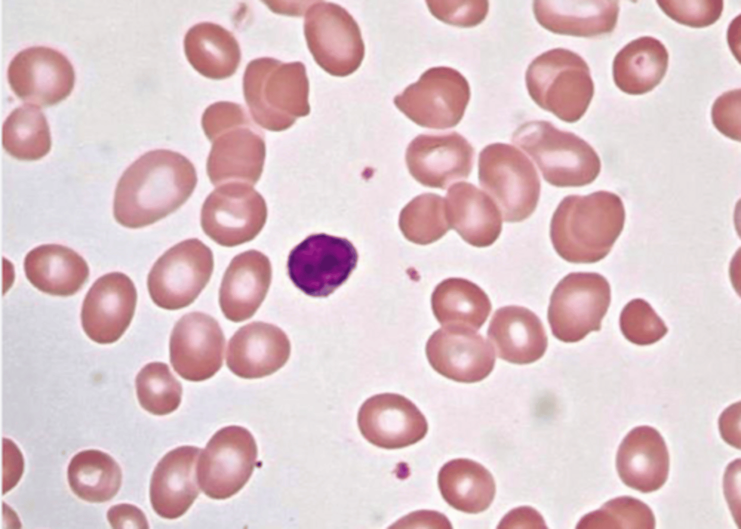 <p>1. bigger size than a lymphocyte nucleus</p><p>2. central pallow = < 1/3 cell diameter</p><p>3. cause: B12/folate deficiency</p>