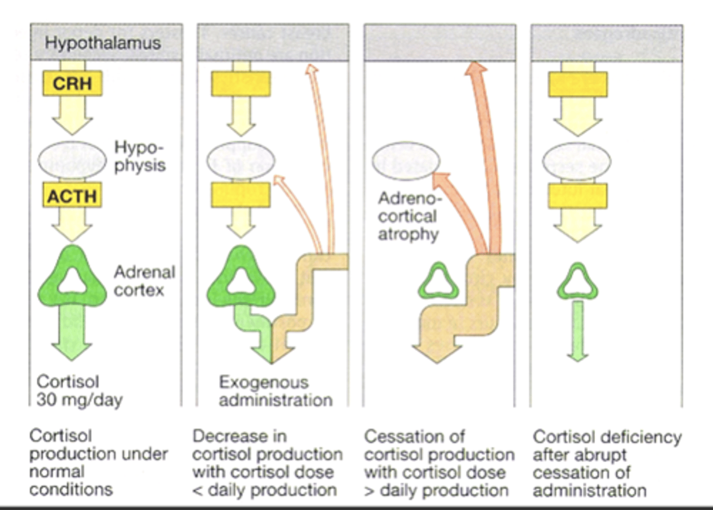 <p>adrenal suppression</p>