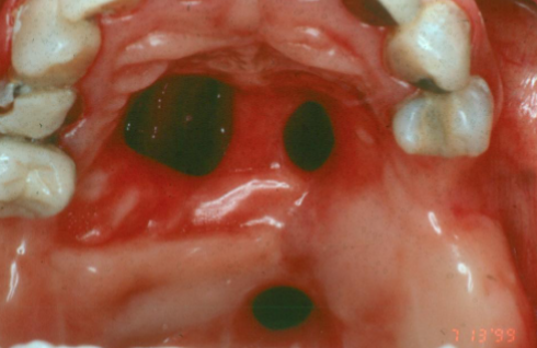 <p>bone necrosis associated with cocaine use, often affecting the nasal cavity </p>