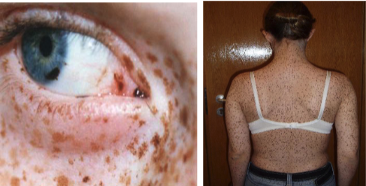 <ol><li><p>Lentigines</p></li><li><p>ECG conduction abnormalities</p></li><li><p>Ocular hypertelorism</p></li><li><p>Pulmonic stenosis</p></li><li><p>Abnormal genitalia</p></li><li><p>Retardation of growth</p></li><li><p>Deafness</p></li></ol><p></p>