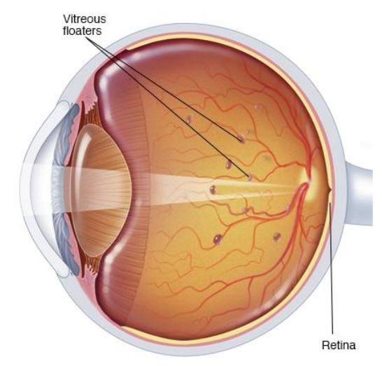 <p>As vitreous gel liquefies, <strong>collagen complexes form clumps &amp; bundles </strong></p><p><strong>Shadows cast on retina</strong>, seen as floating spots </p><p>Most <strong>noticeable on white wall/blue sky  </strong></p><p>May be a <strong>sign of retinal pathology</strong></p>