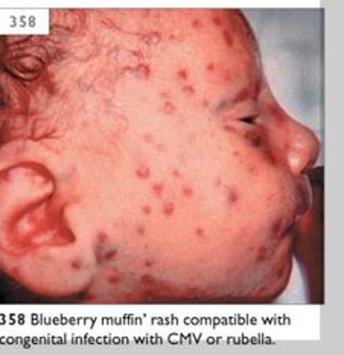 <p>Pediatricians initially coined the term blueberry muffin baby to describe cutaneous manifestations observed in newborns infected with rubella during the American epidemic of the 1960s. These children had generalized hemorrhagic purpuric eruptions that, on histopathology, showed dermal erythropoiesis producing red or purple spots on the skin that look like a "Blueberry Muffin" - Since then, congenital infections comprising the TORCH syndrome (toxoplasmosis, other, rubella, cytomegalovirus, herpes) and hematologic dyscrasias have classically been associated with blueberry muffin-like lesions.</p>