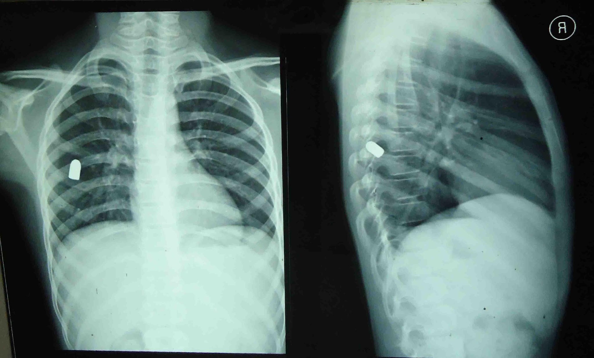 <p>Over penetration</p>