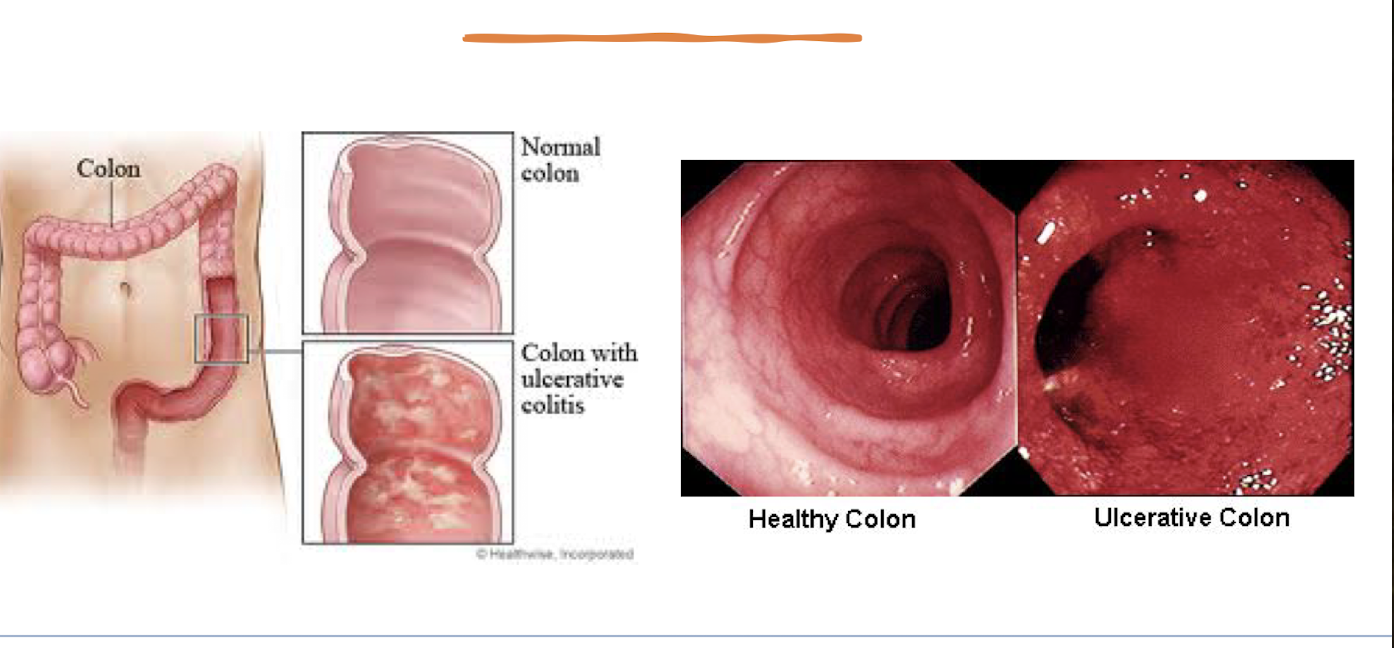 <ul><li><p>type of inflammatory bowel disease (progressive inflammatory movement)</p></li><li><p>bowel wall edema</p></li><li><p>shallow, coalescent ulcerations: pseudopolyps</p></li><li><p>prone to undergo malignant change</p></li></ul><p></p>