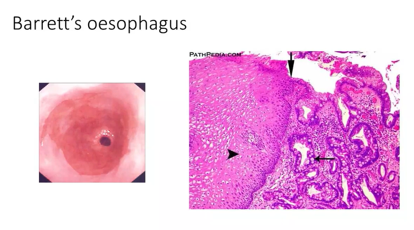 <ul><li><p>example of metaplasia </p></li><li><p>oesophagus is <em>usually </em>lined with <u>squamous </u>cell epithelium </p></li><li><p>stomach is lined by <u>glandular </u>epithelium- produces acids and enzymes - but is resistant to these products </p></li><li><p>squamous epithelium is <em>easily damaged </em>- so its therefore important to keep the stomach contents within the stomach via the lower oesophageal sphincter - but in reflux there is escape into lower oesophagus - damages the epithelium - the body can change the type of epithelium here to combat this - makes itself glandular - notice how the mucosa looks more red instead of paler </p></li><li><p>right image shows the interface between the pale and the red mucosa </p></li></ul><p></p>