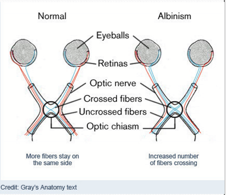 <p>Albinism leads to improper routing of ganglion cells through the optic chiasm. Fewer ipsilateral projections of RGC axons. </p>