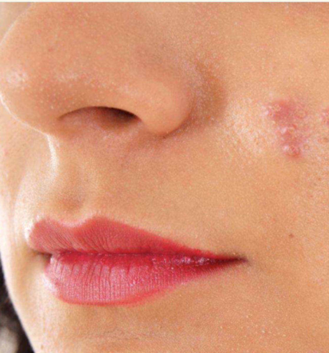 <p>¿lesión?</p><p>¿primaria o secundaria?</p>