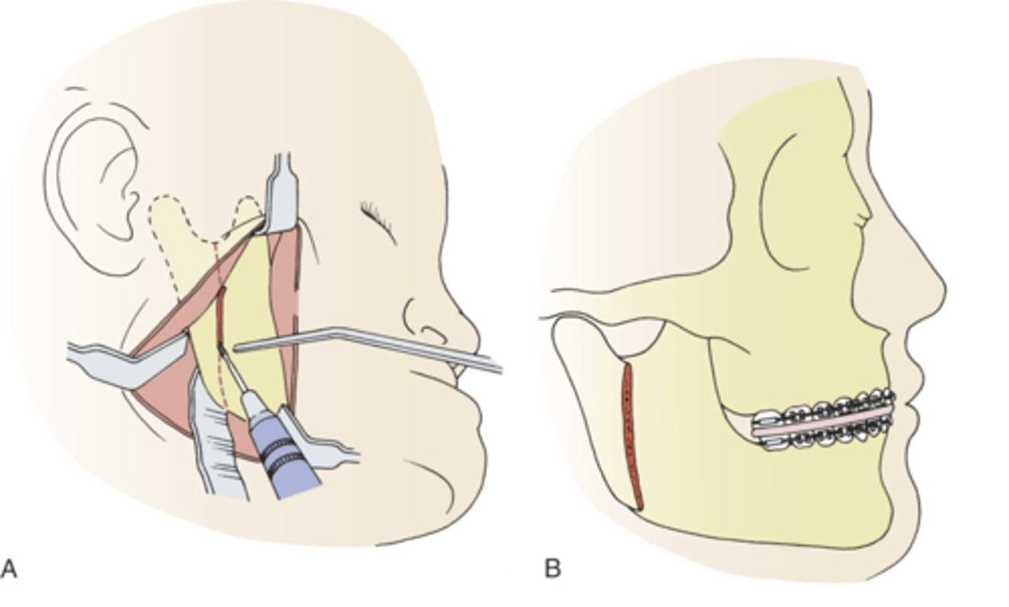 <p>- cuts the mandibular (lower jaw) ramus vertically to allow for repositioning of the jaw for orthognathic surgery, which corrects facial deformities.</p><p>- used to treat conditions like mandibular prognathism and hemifacial microsomia, and is sometimes called intraoral vertical ramus osteotomy (IVRO) if performed inside the mouth</p>