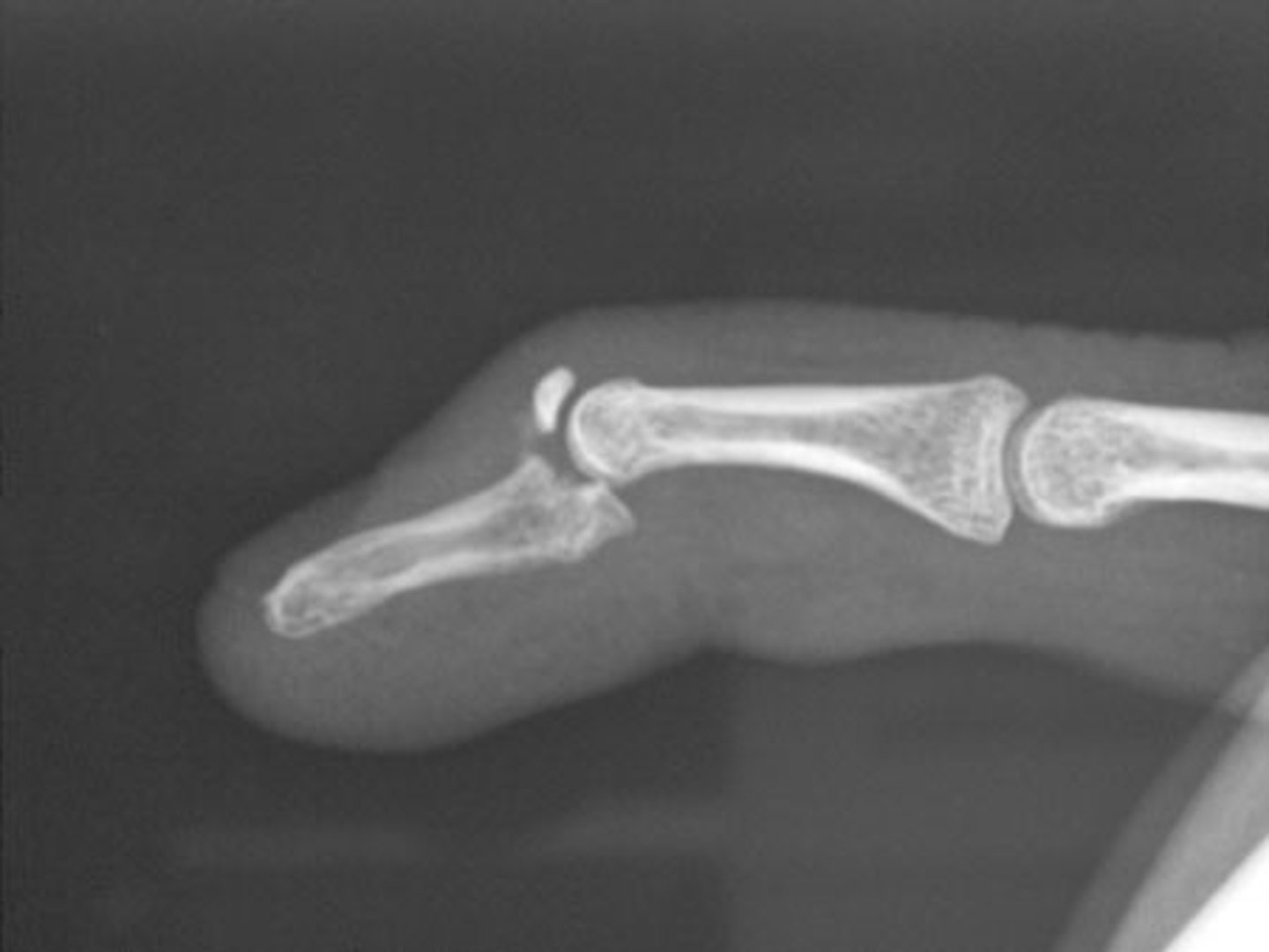 <p>extensor digitorum avulsion or rupture that causes inability to actively extend the DIP, which assumes the posture of 25-35 degrees of flexion</p>