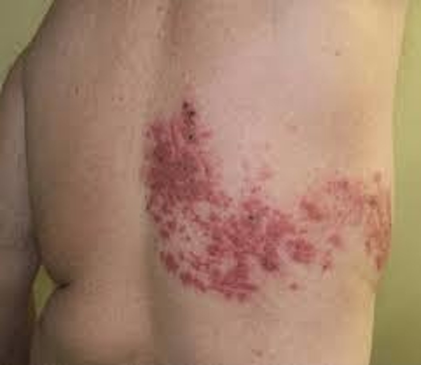 <p>-Shingles</p><p>-Usually along nerve track (unilateral)</p><p>-Contagious if draining pustules are present</p><p>-Vaccine are given for this for individuals 55 and up (2 part series, 6 months apart)</p>