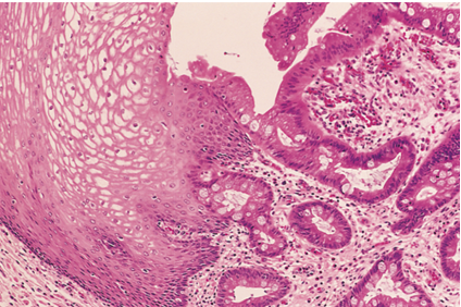 A 34-year-old obese woman has experienced heartburn from gastric reflux for the past 5 years after eating large meals. She undergoes upper gastrointestinal endoscopy, and a biopsy specimen of the distal esophagus is obtained. Which of the following microscopic changes, seen in the figure, has most likely occurred?