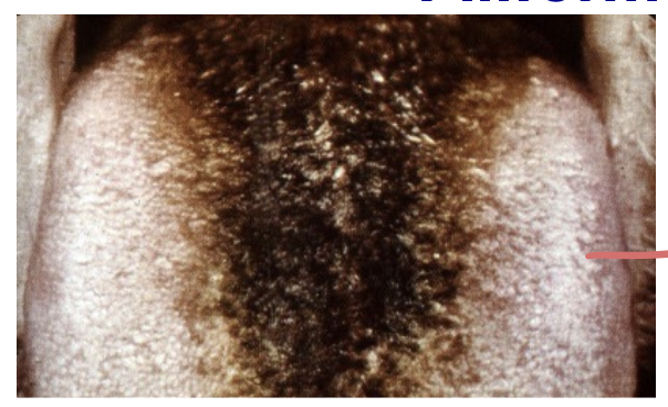 <p>over keratinized of filiform papillae </p>