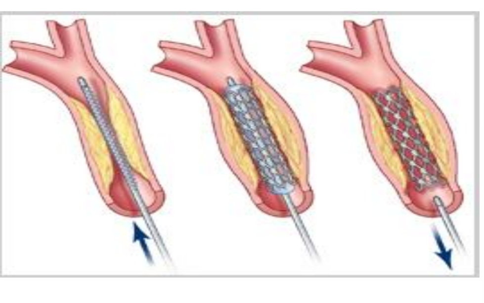<p> Stent is placed in the narrowed</p><p>region</p><p> Potential for emboli; basket “placed”</p><p>above narrowed region to catch any</p><p>emboli</p>