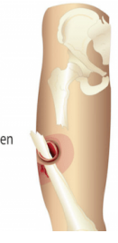 <p>When there is an open wound over a fracture, the fracture is also described as _____.</p>