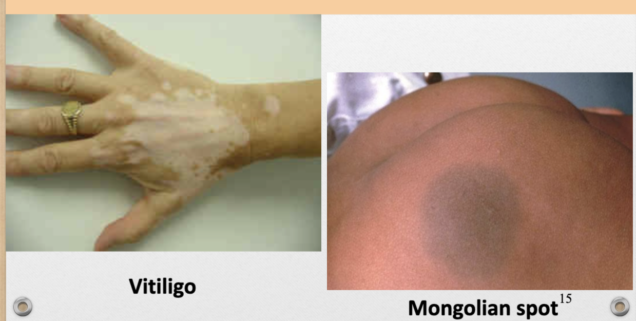 <p>ex. vitiligo, mongolian spot</p>