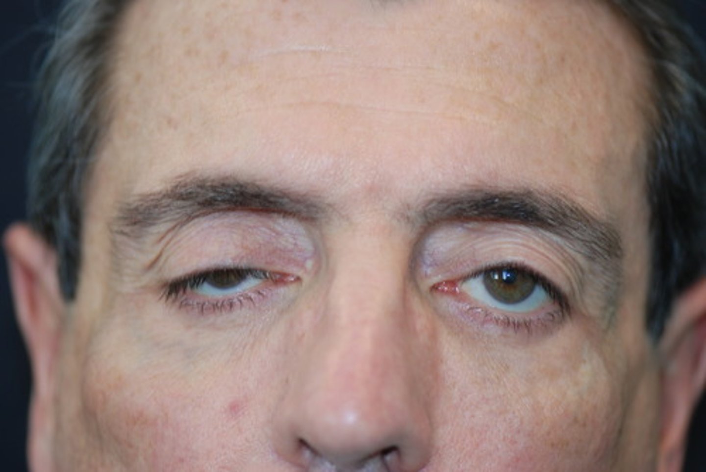 <p>eyelid prolapse, downward displacement</p>