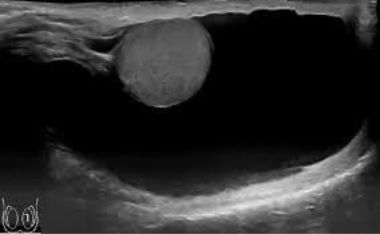 <p>Located between the two layers of tunica vaginalis; SA: anechoic fluid filled in the scrotal sac surrounding testicles and epididymis, may contain debris or septations</p><p>CI: Asymptomatic or pt. c/o of scrotal enlargement </p>