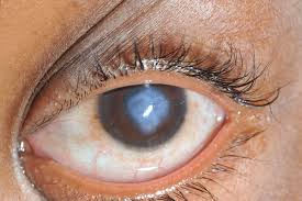 <ul><li><p><span><strong>Reduced vision</strong></span></p></li><li><p><span><strong>Pain</strong></span></p></li><li><p><span><strong>Photophobia</strong></span></p></li><li><p><span><strong>Watery eye</strong></span></p></li><li><p><span>Intolerable CL wear</span></p></li></ul><p></p>