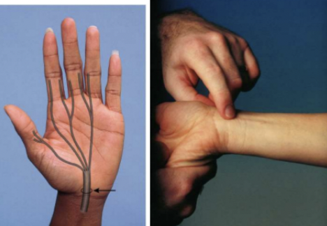 <p><span style="font-family: Calibri, sans-serif">Carpal tunnel syndrome</span></p><ul><li><p><span style="font-family: Calibri, sans-serif">Positive sign is a tingling sensation in the distribution of the median nerve</span></p></li></ul><p></p>