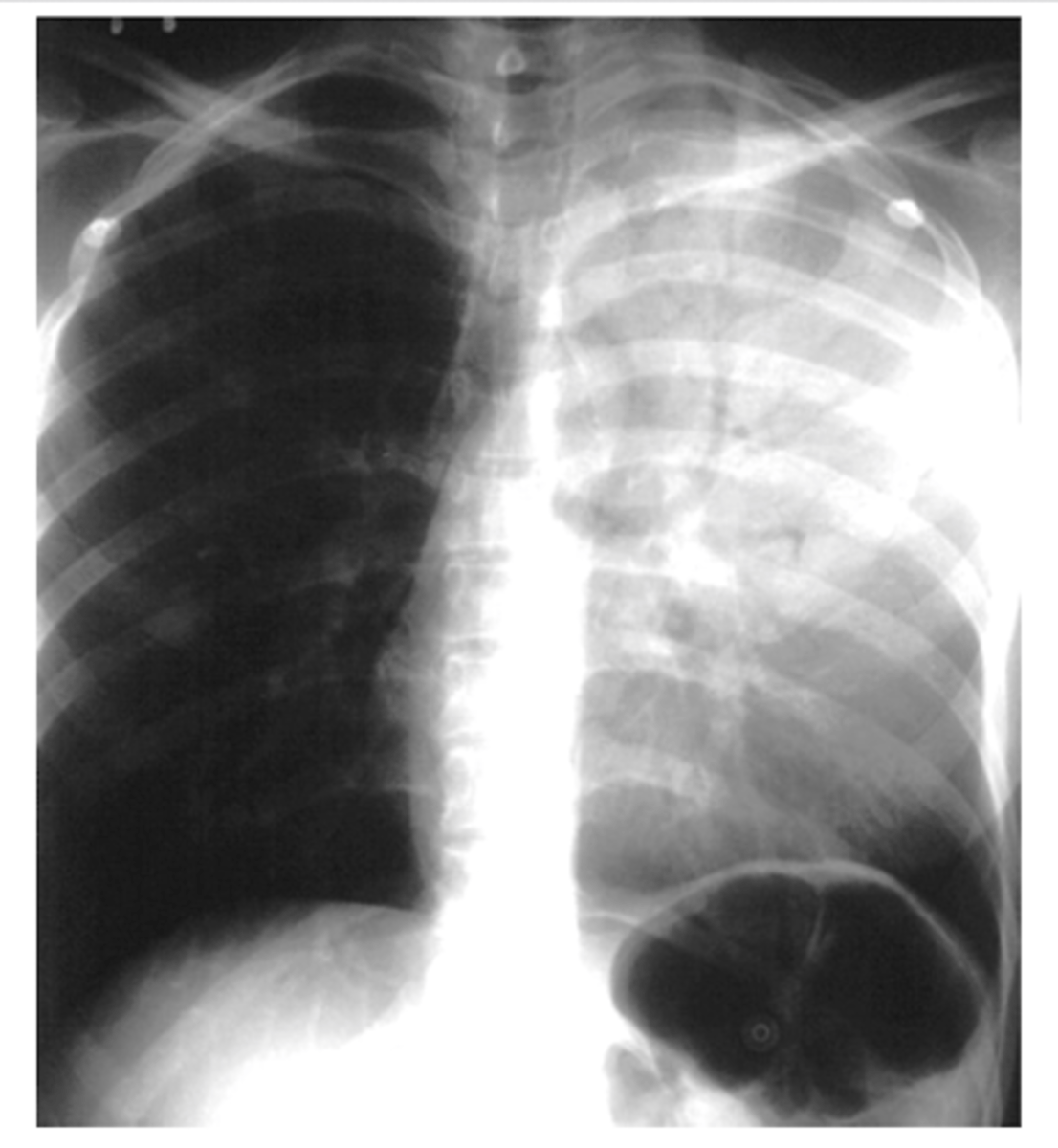 <p>Pneumonia.</p><p>The infection causes the alveoli to fill with fluid.</p>