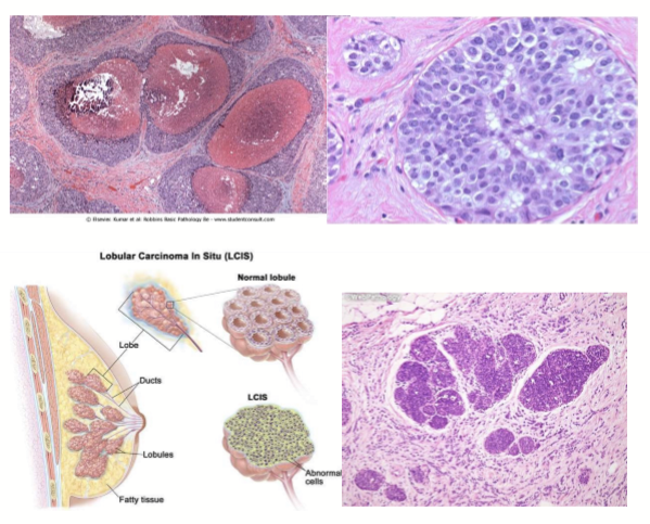 <ol><li><p>Ductal carcinoma in situ (DCIS) </p></li><li><p>Lobular CIS (LCIS) </p></li></ol><p></p>