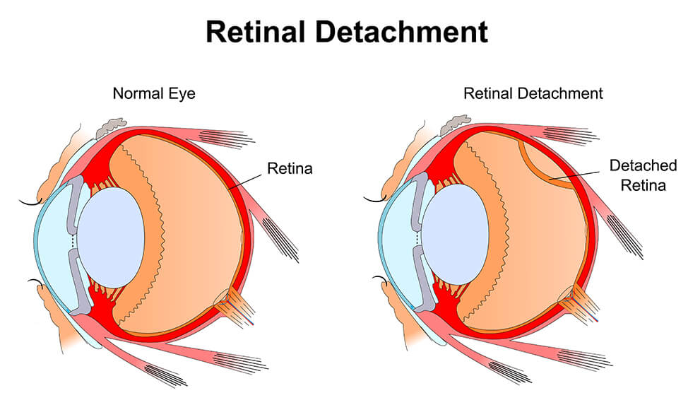 <p>What is non-congenital retinal detachment?</p>