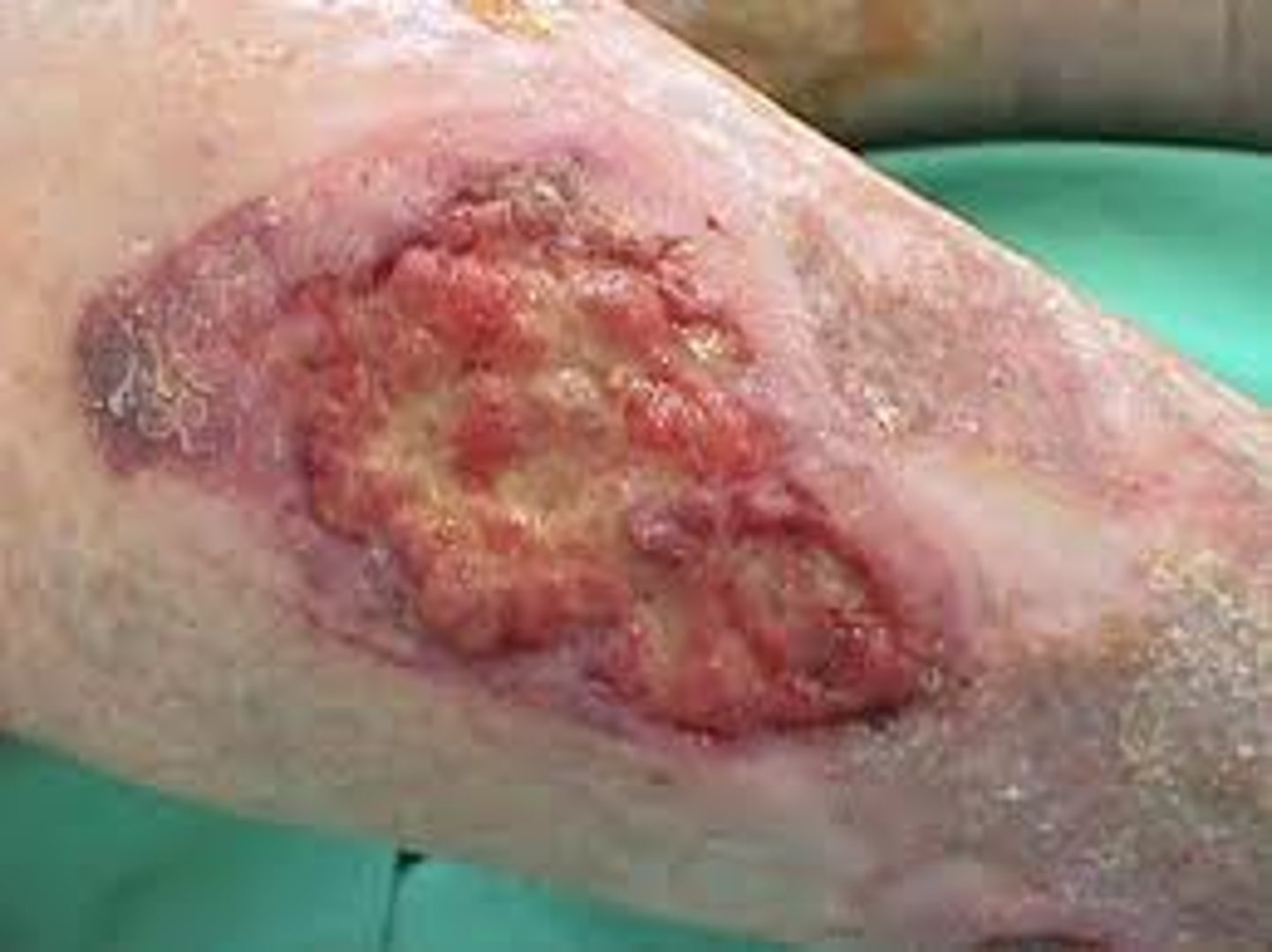 <p>Squamous cell carcinoma ulceration overlying chronic osteomyelitis or <strong>burn</strong> scar</p>