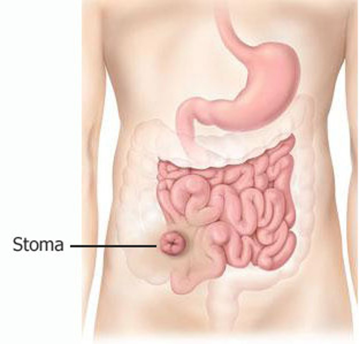 <p>creation of an artificial opening into the ileum</p><p>* stool is liquid and watery (small intestine)</p><p>* loose/ watery stool</p>