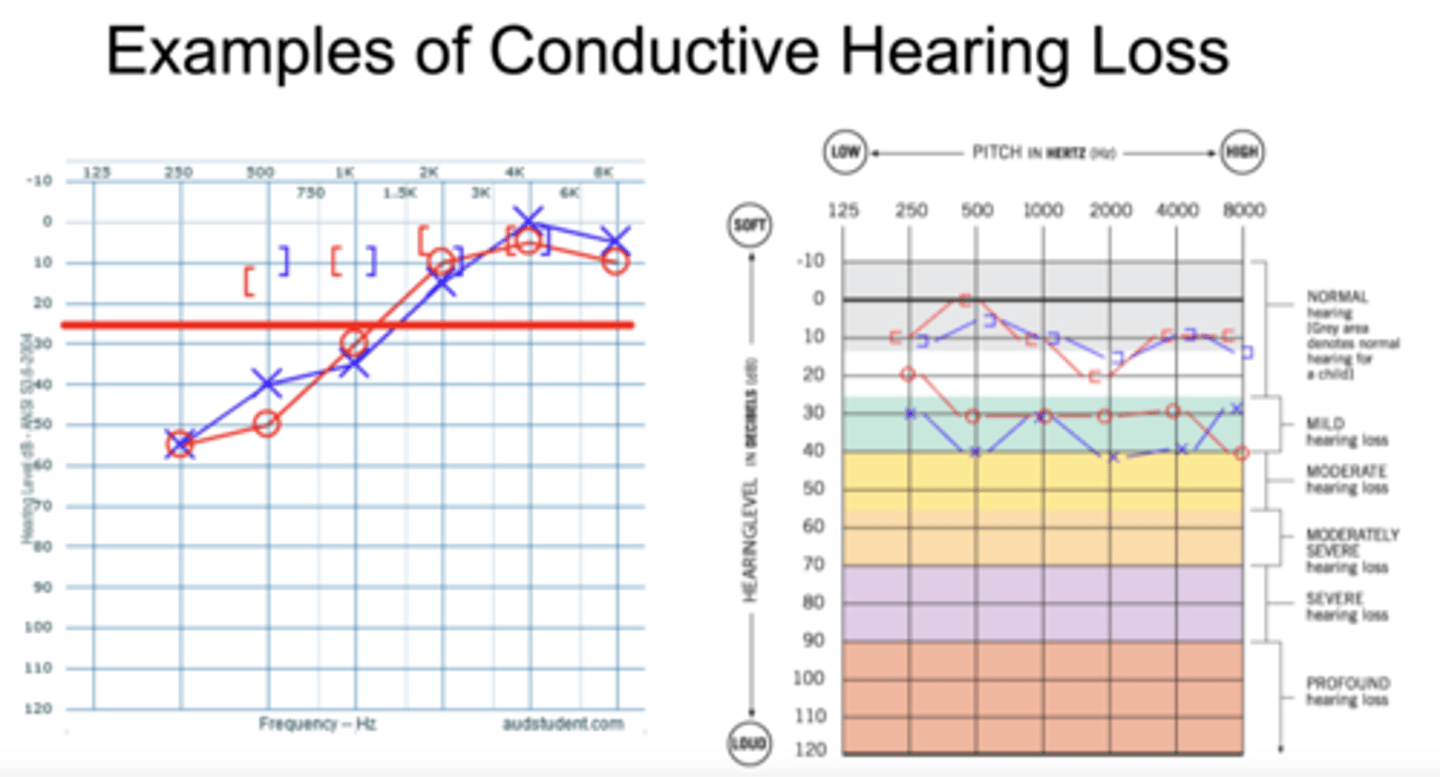 <p>Hearing loss originates from the outer or middle ear.</p><p>Audiogram: No bone conduction loss, air conduction loss, and air-bone gap greater than 10 dB.</p>