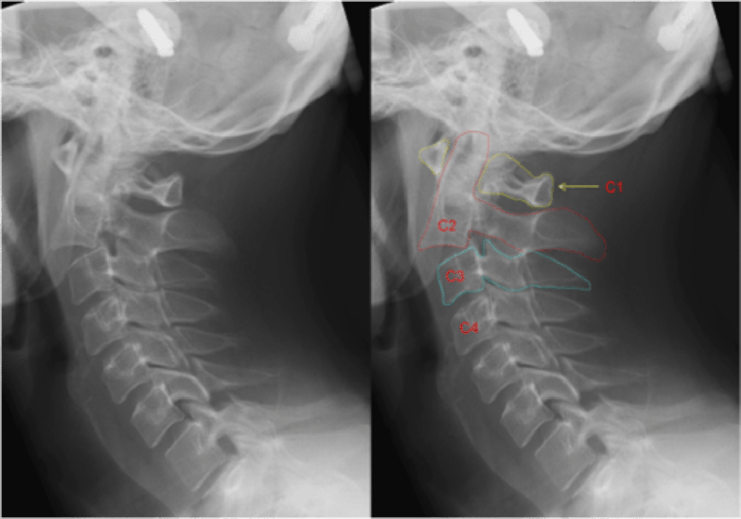 <p>bilateral pars interarticularis of C2</p>