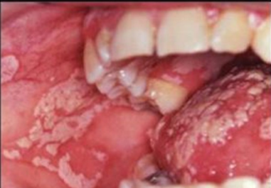 <p>painful, creamy-white curd like patches over erythematous mucosa caused by an infection of Candida albicans </p>