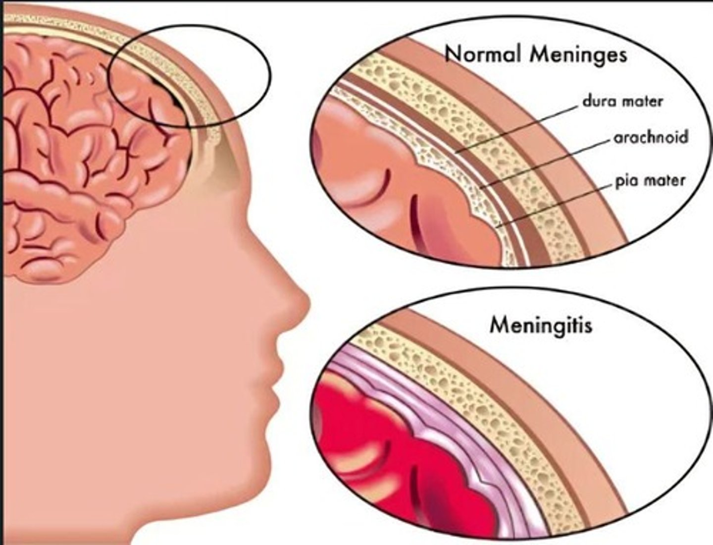 <p>Inflammation of the meninges that surround the brain and spinal cord.</p>