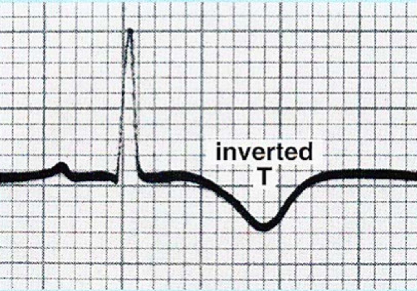 <p>- T wave inversion</p><p>- Ischemia is caused by a decrease in oxygen to the myocardial tissue (hypoxia/diminished blood supply)</p><p>- can still save heart cells/reverse</p>