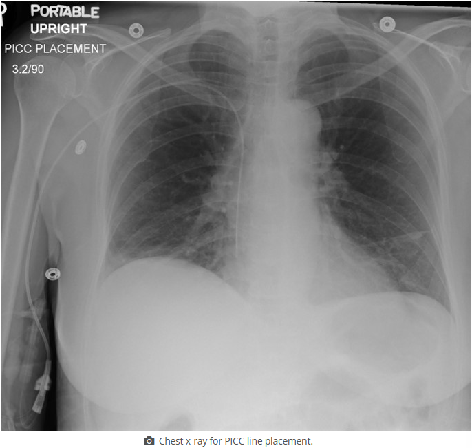 <p>find the PICC line in this image</p>