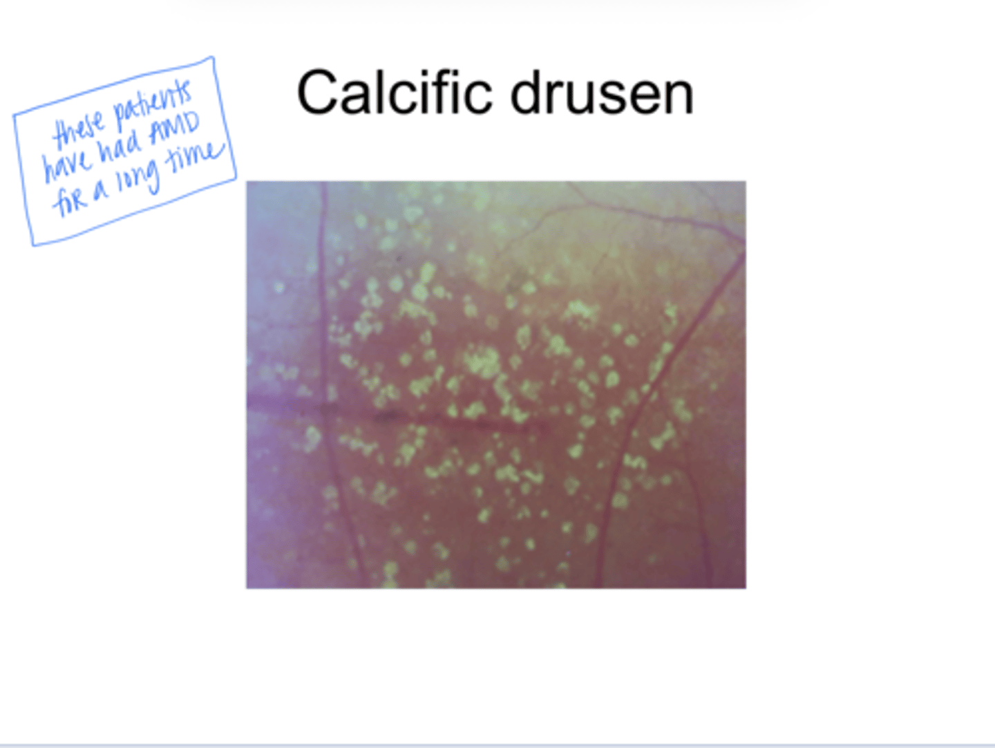 <p>Calcific drusen (Pic)</p>