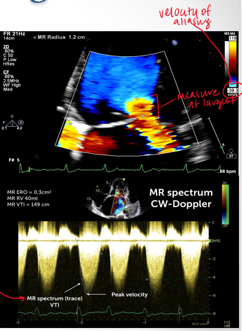 <p>velocity of aliasing&nbsp;</p><p>pisa radius</p><p>VTI trace</p>