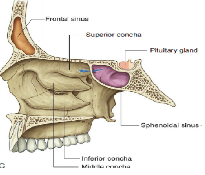 <p>What are the implications of a sphenoid sinus fracture?</p>