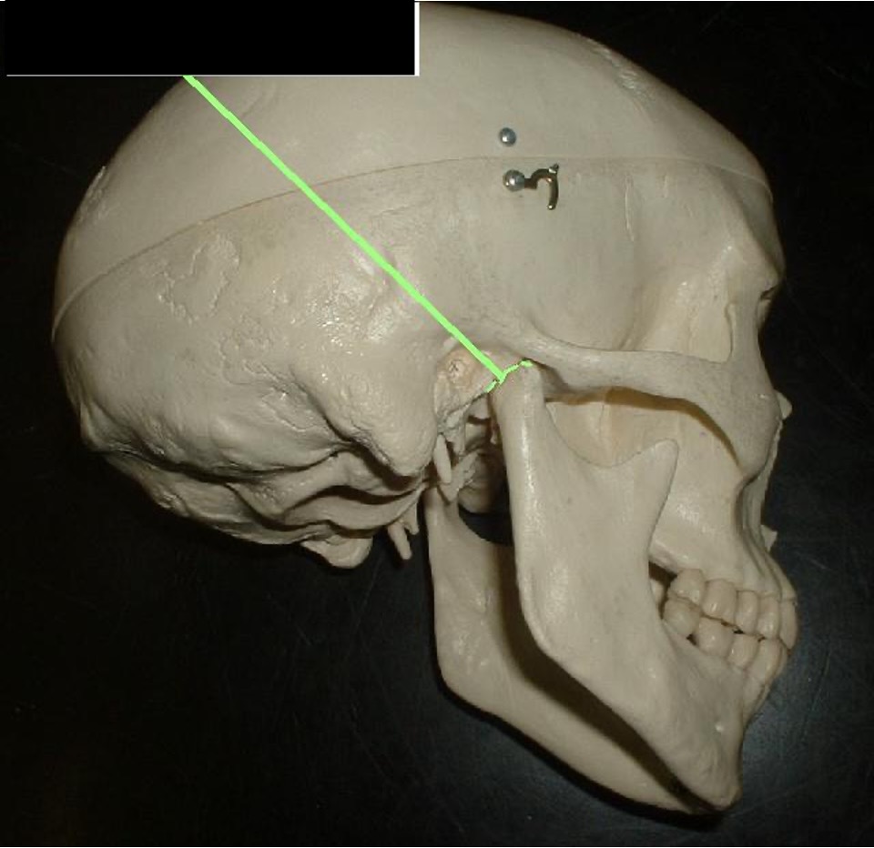 <p>a dent that the mandible fits into; it is in front of the ear lobe.</p>