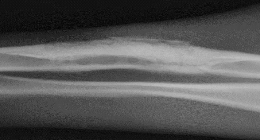 <p>Focal or Regional Bone Loss</p>