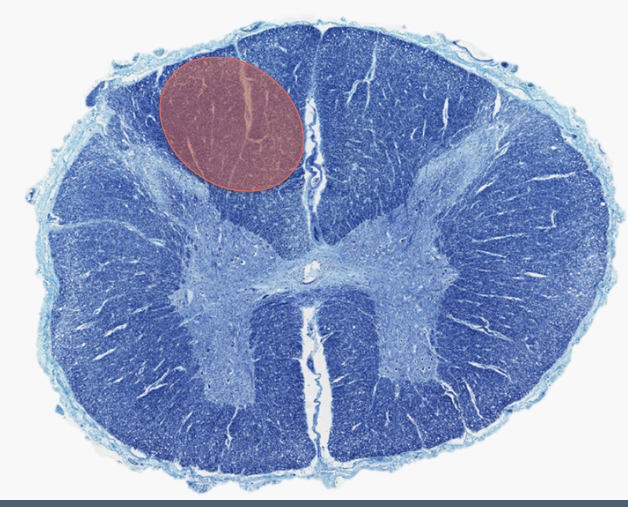 <p>What would be the major deficit of the lesion indicated ?</p>