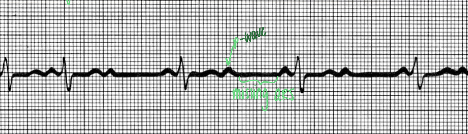 <ul><li><p>more P waves than QRS waves; missing QRS waves</p></li><li><p>&quot;second degree heart block&quot;</p></li></ul>