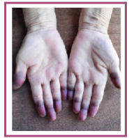 Also known as Acrocyanosis is usually related to reduced extremity blood flow due to small vessel constriction
○ Severe heart failure, shock, or peripheral vascular disease