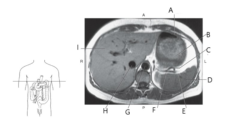 <p>Gastro splenic</p>
