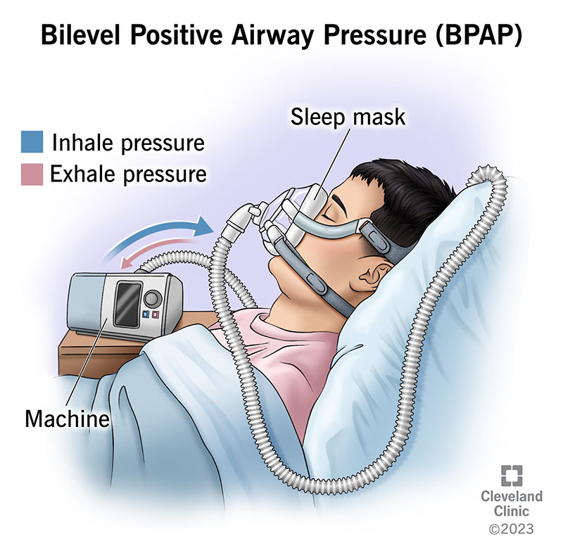 <p>BIPAP! </p><p></p><p>(<em>Not CPAP → cpap only gives oxygen and does not ventilate)</em></p>