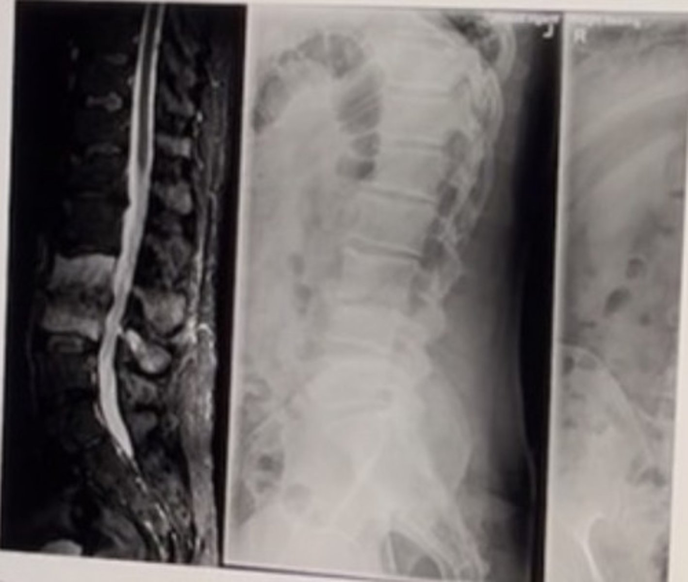 <p>Diabetic patient with low back pain of 3 weeks that is getting progressively worse.</p><p>Most likely diagnosis:</p><p>Chordoma</p><p>Metastasis</p><p>Kummel's disease</p><p>Infectious discitis</p>