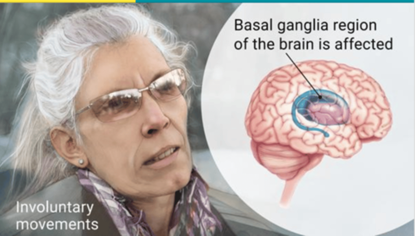 <p>A human genetic disease caused by a dominant allele that causes the progressive breakdown of nerve cells in the brain; those affected develop signs and symptoms in their 30s or 40s. But the disease may emerge earlier or later in life; treat symptoms but no cure</p>