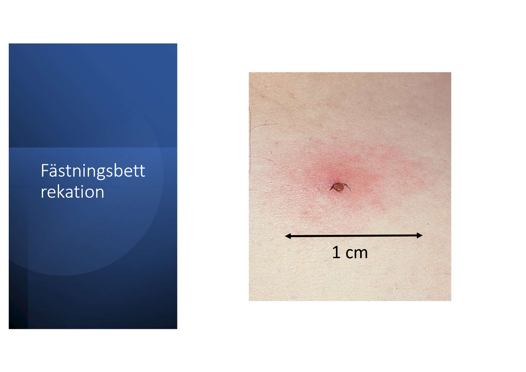<p>Oftast bara 1 cm.</p><p>Sen försvinner det inom några dagar (när fästingen inte är infekterad av borrelia bakterien). </p>