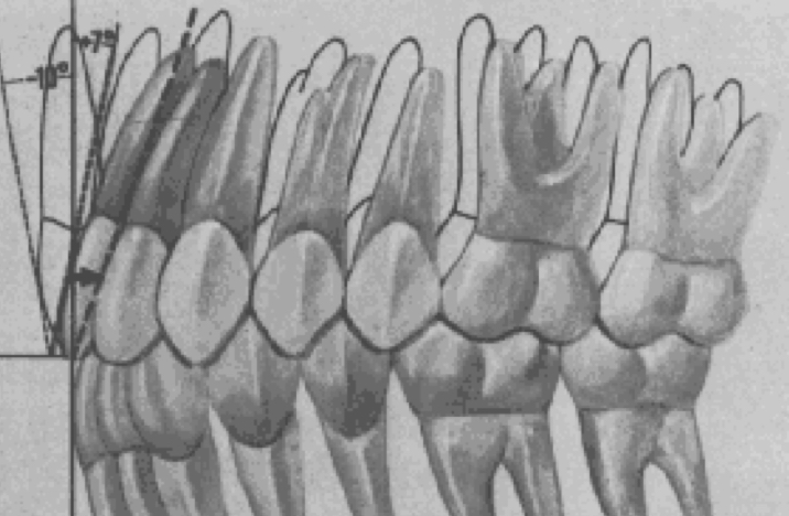 <p>upper and lower anterior crown inclinations are intricately complementary and significantly affect overbite and posterior occlusion</p><ul><li><p>positive upper anterior crown inclination</p></li></ul><p></p>