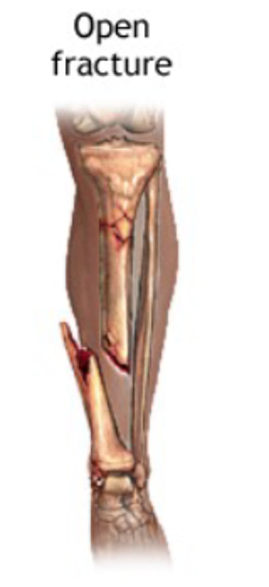 <p>open (compound) fracture</p>