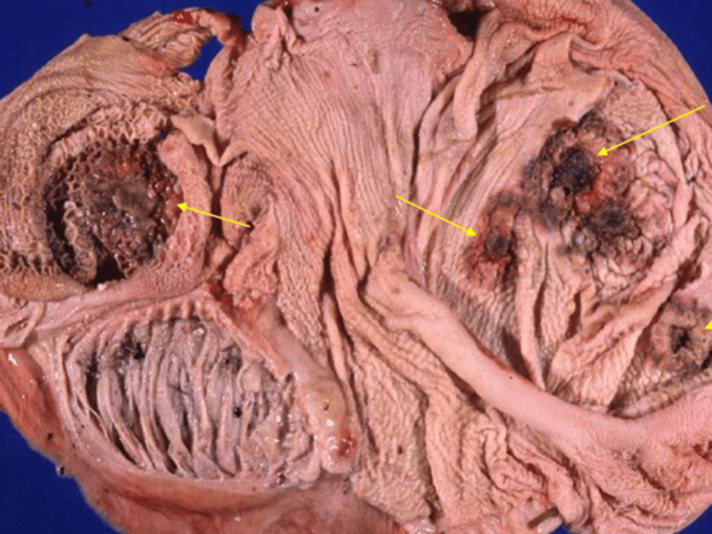 <p>What are the most common agents in mycotic rumenitis?</p>